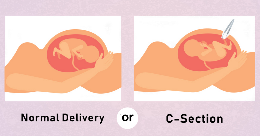 Natural delivery vs. cesarean section